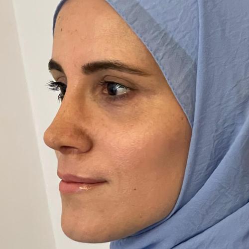 Septorrinoplastia Foto antes/después